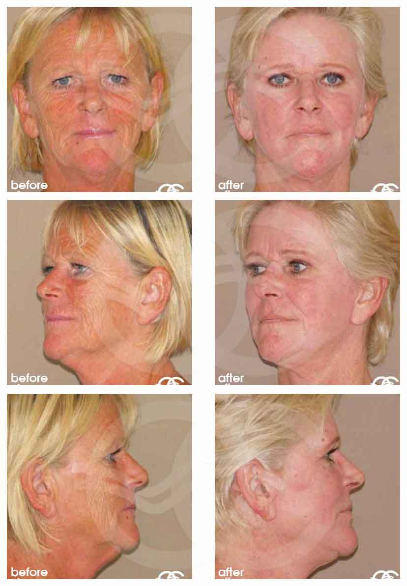 facial peel Deep