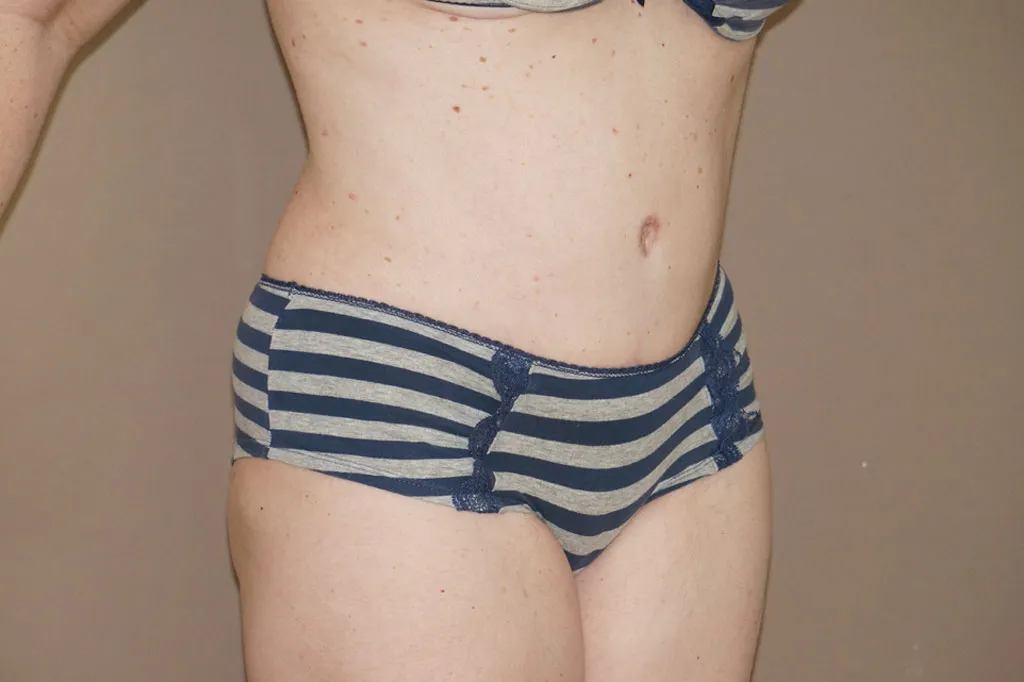 Resultado después de Abdominoplastia –  vista 3/4