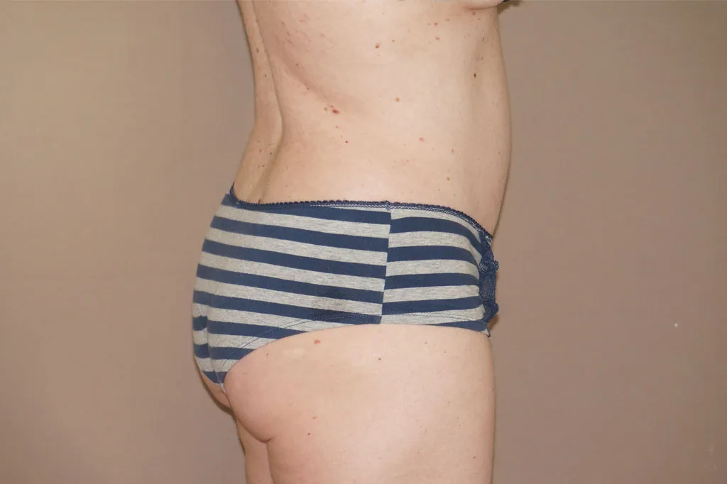 Resultado después de Abdominoplastia – vista lateral