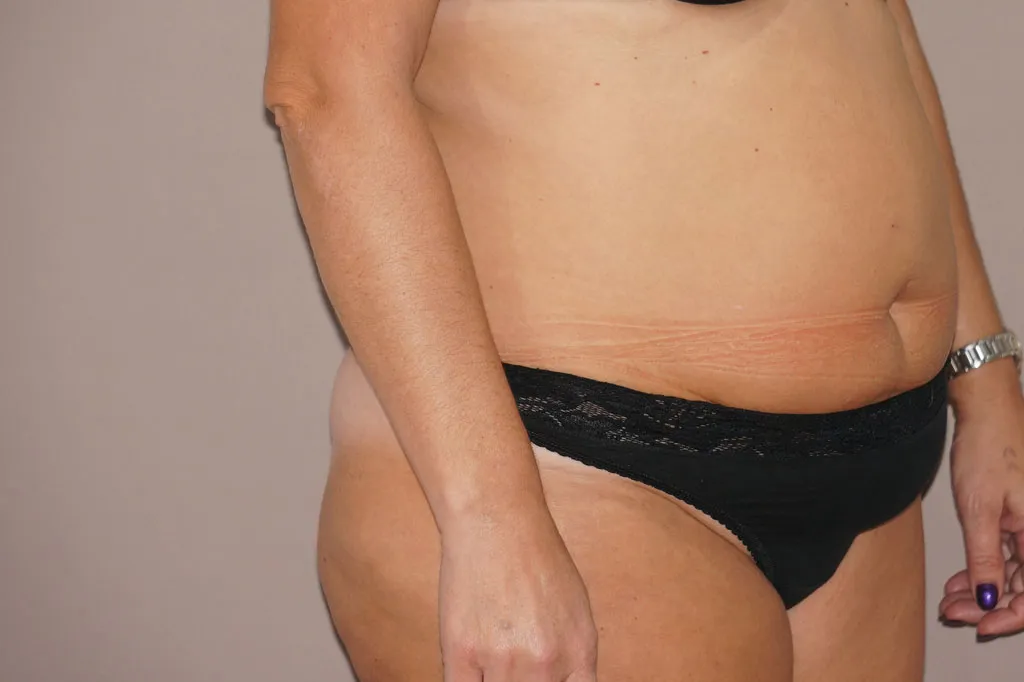 Abdominoplastia antes de la cirugía – vista 3/4
