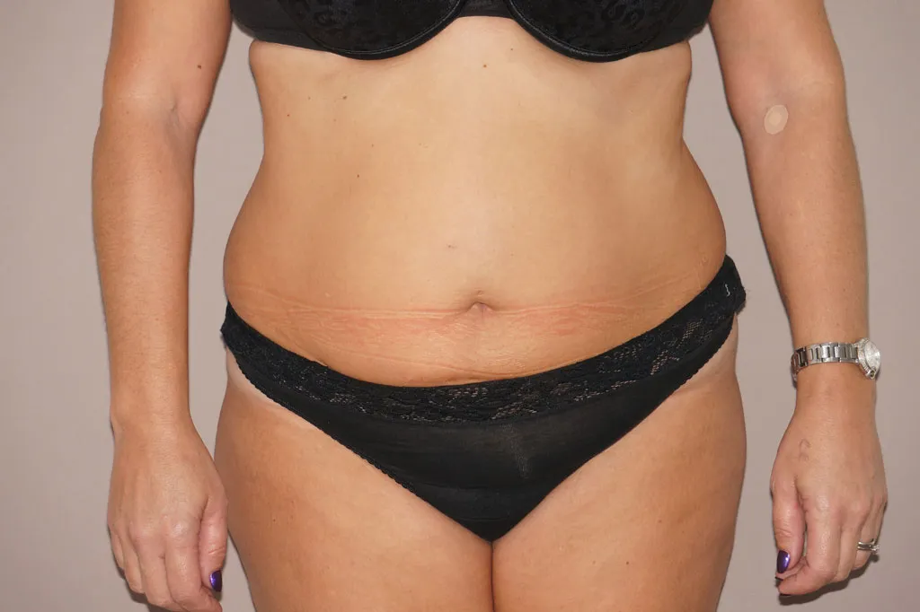 Abdominoplastia en Marbella antes de la cirugía – vista frontal