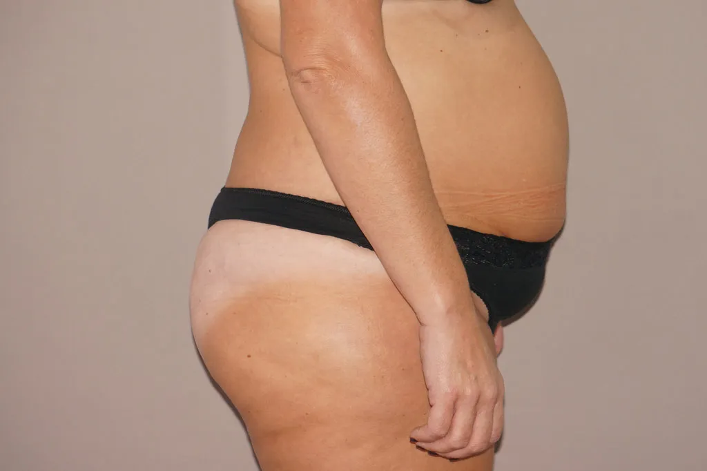 Abdominoplastia antes de la cirugía – vista lateral