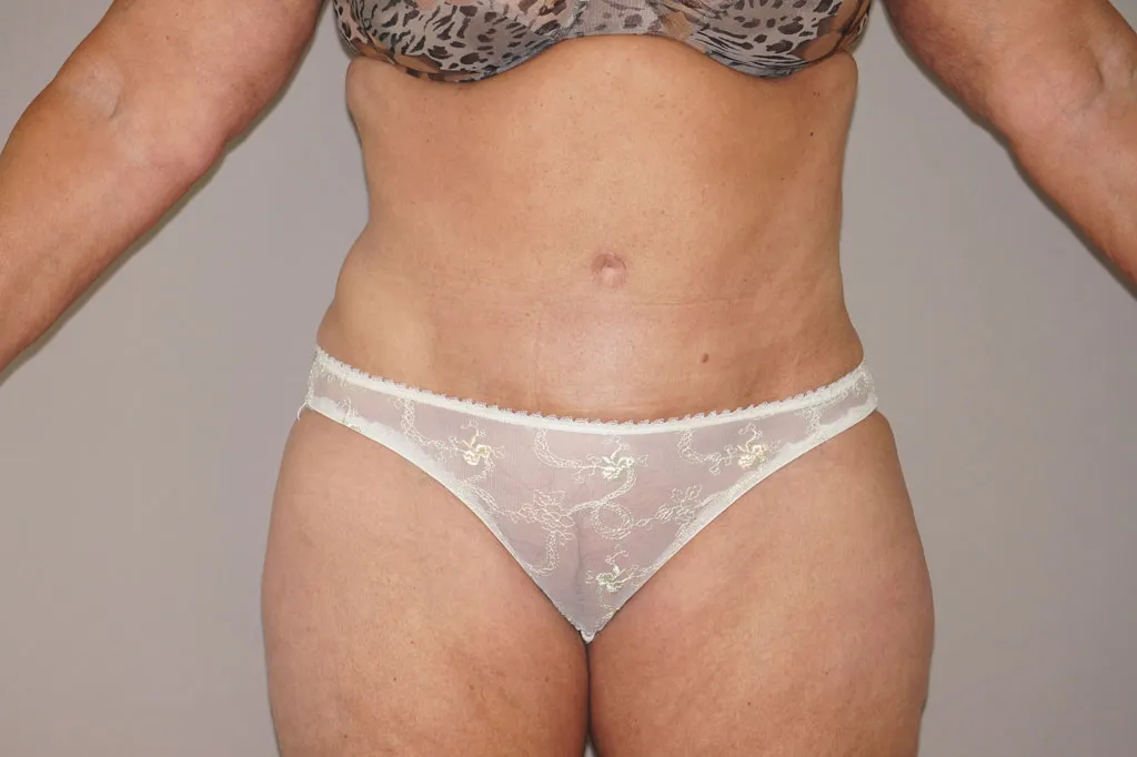Resultado después de Abdominoplastia – vista frontal