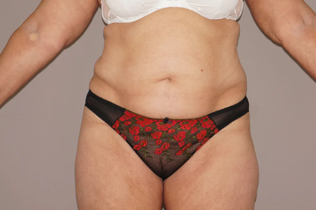 Abdominoplastia en Marbella antes de la cirugía – vista frontal