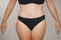 Caso real Abdominoplastia Marbella - 02