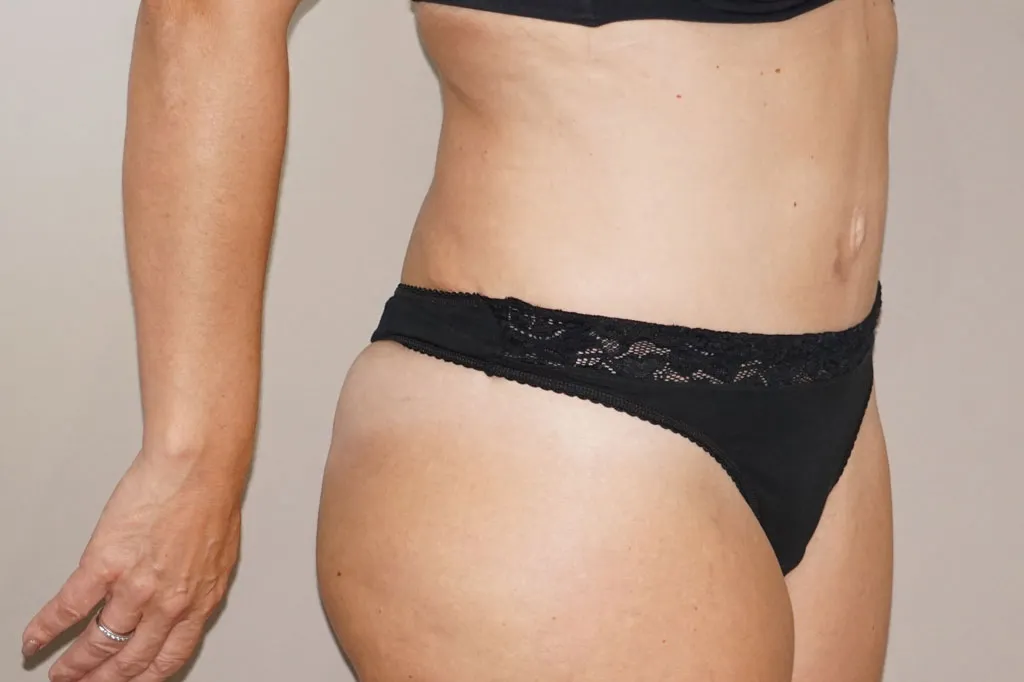 Resultado después de Abdominoplastia –  vista 3/4