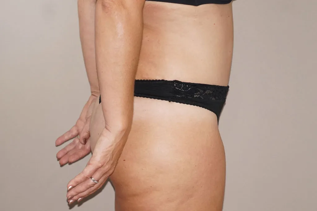 Resultado después de Abdominoplastia – vista lateral