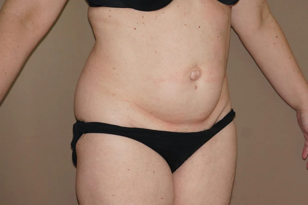 Abdominoplastia antes de la cirugía – vista 3/4