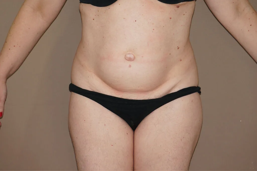Abdominoplastia en Marbella antes de la cirugía – vista frontal