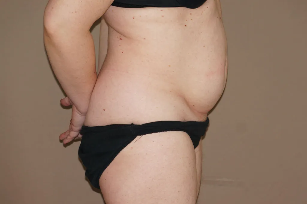 Abdominoplastia antes de la cirugía – vista lateral