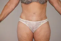 Caso real Abdominoplastia Marbella - 03