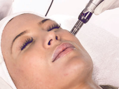 Microneedling