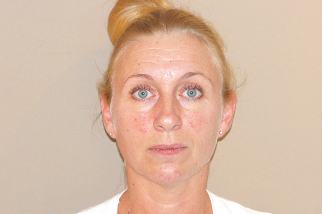 Photos Chemical Denervation  ante/post-op I
