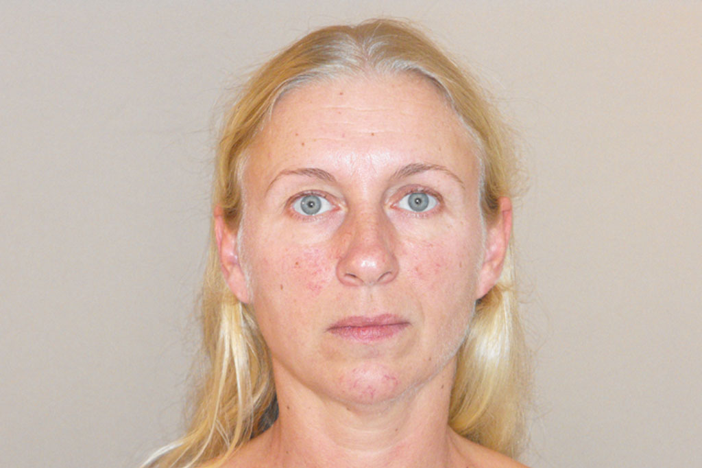 Photos Chemical Denervation  ante/post-op I