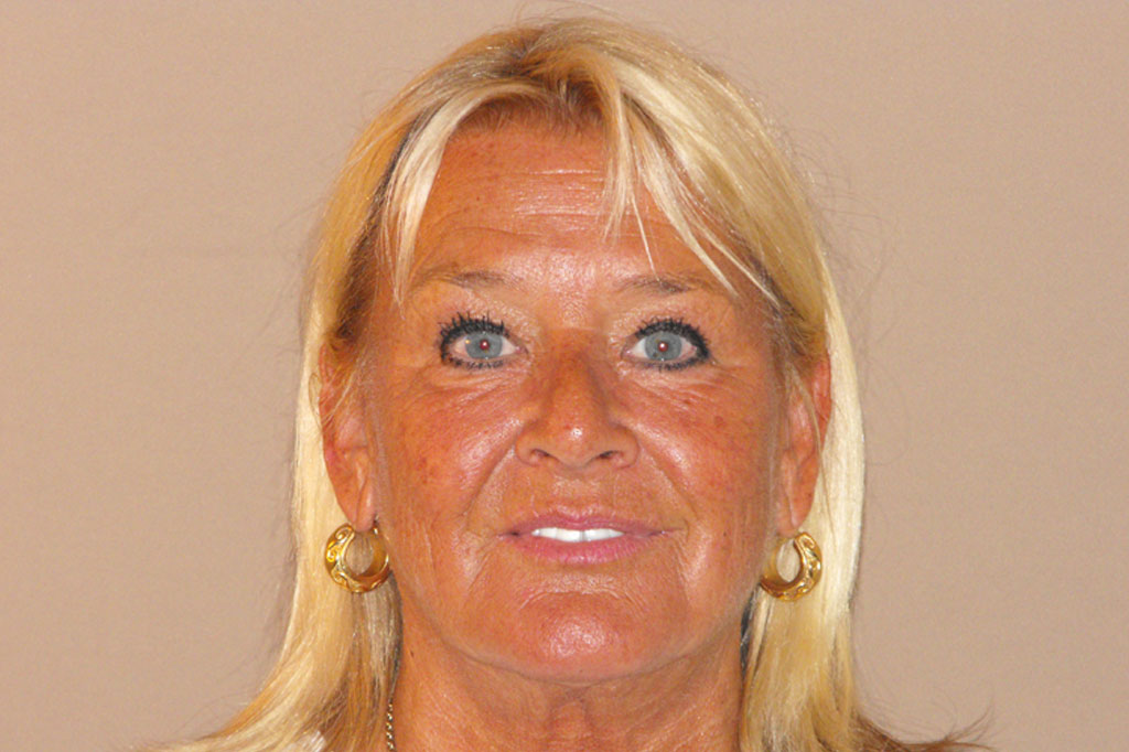 Botox Botulinumtoxin Gesichtsverjüngung ante-op profil