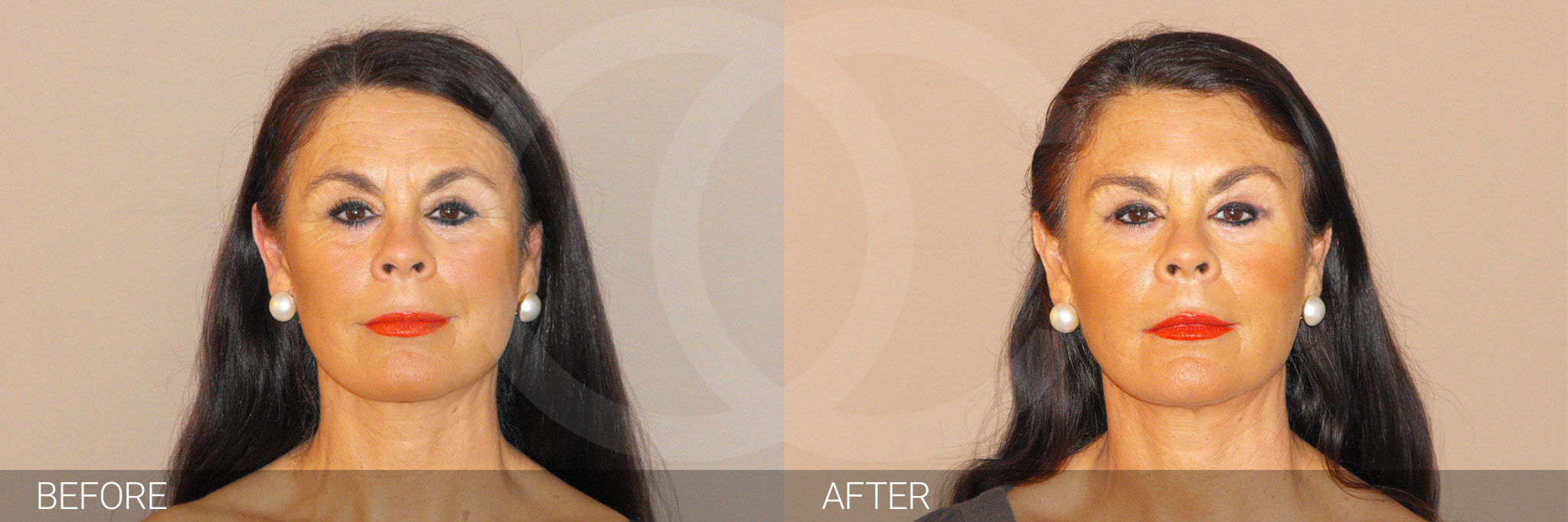 Cosmetic Facial Injections Injections ante/post-op I