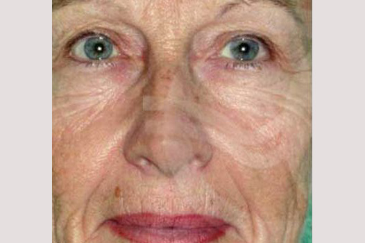Photos Deep Peeling  ante/post-op I