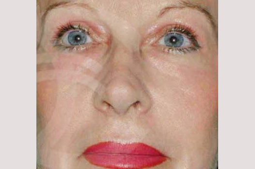 Photos Deep Peeling  ante/post-op I