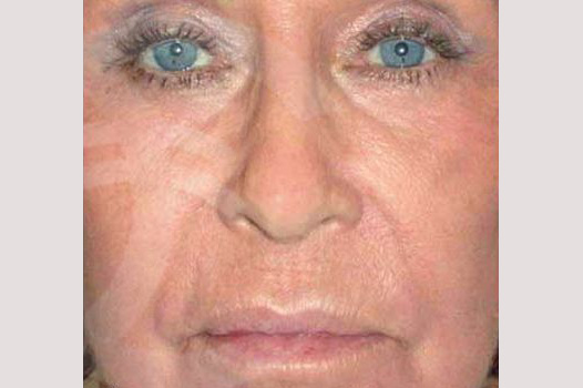 Photos Deep Peeling  ante/post-op I