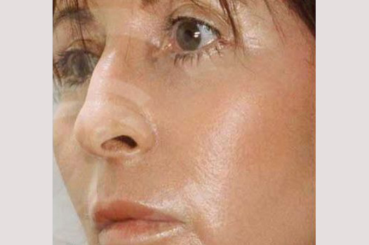 Photos Deep Peeling  ante/post-op I
