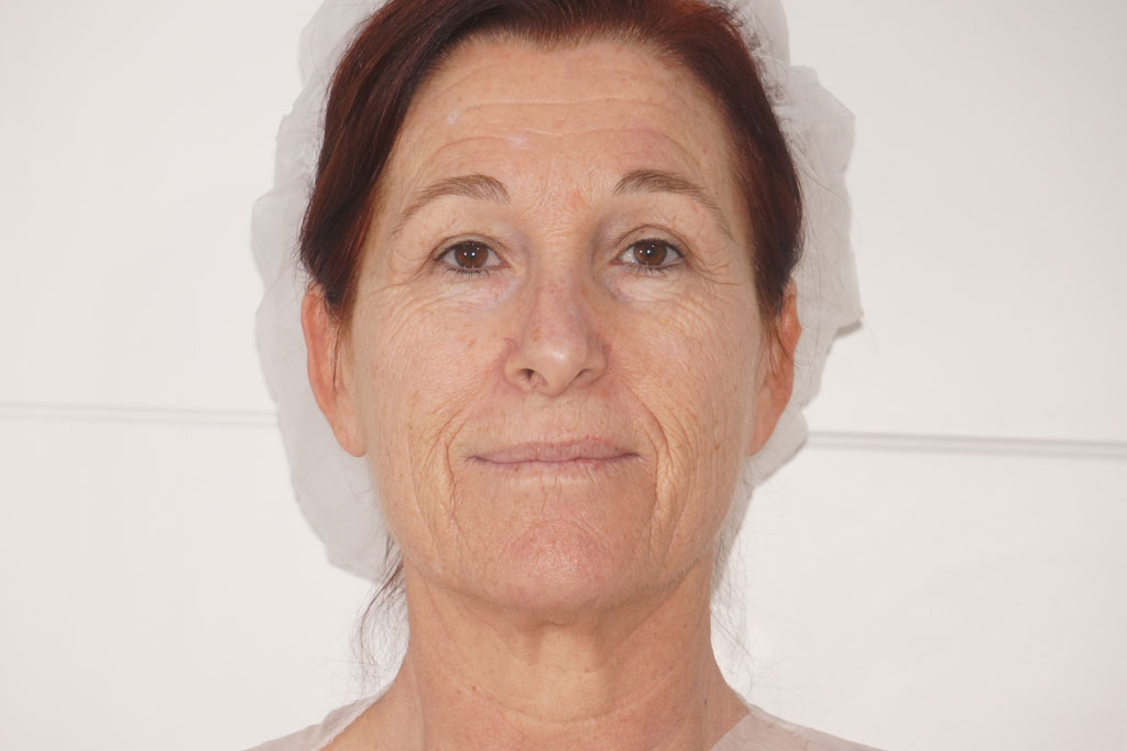 Peeling profundo FENOL ROSTRO COMPLETO ante/post-op I