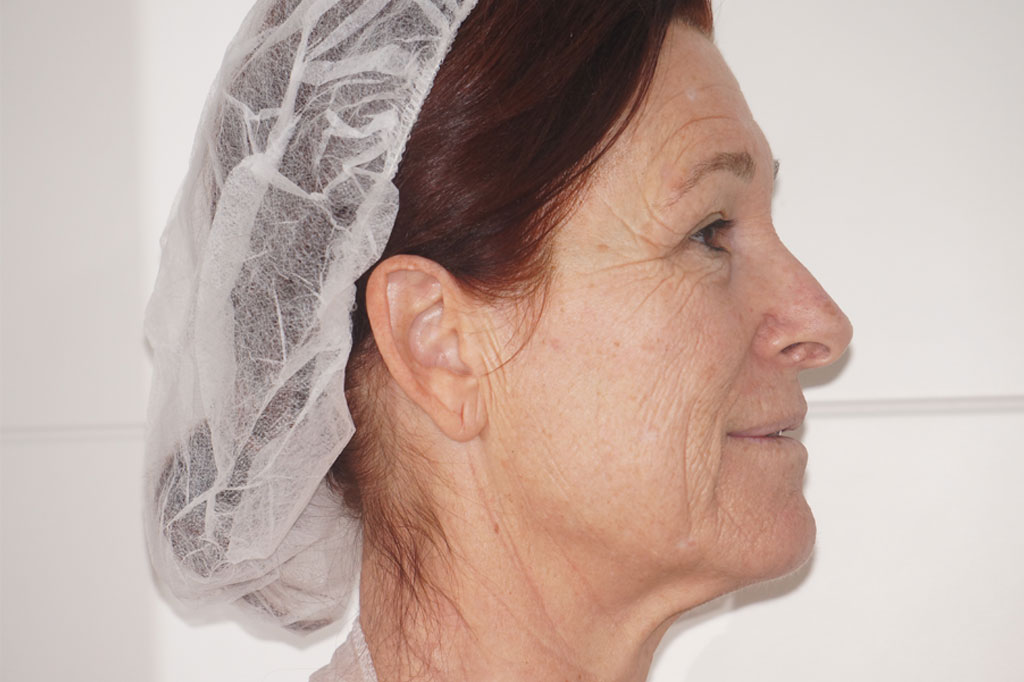 Peeling profundo FENOL ROSTRO COMPLETO ante/post-op II