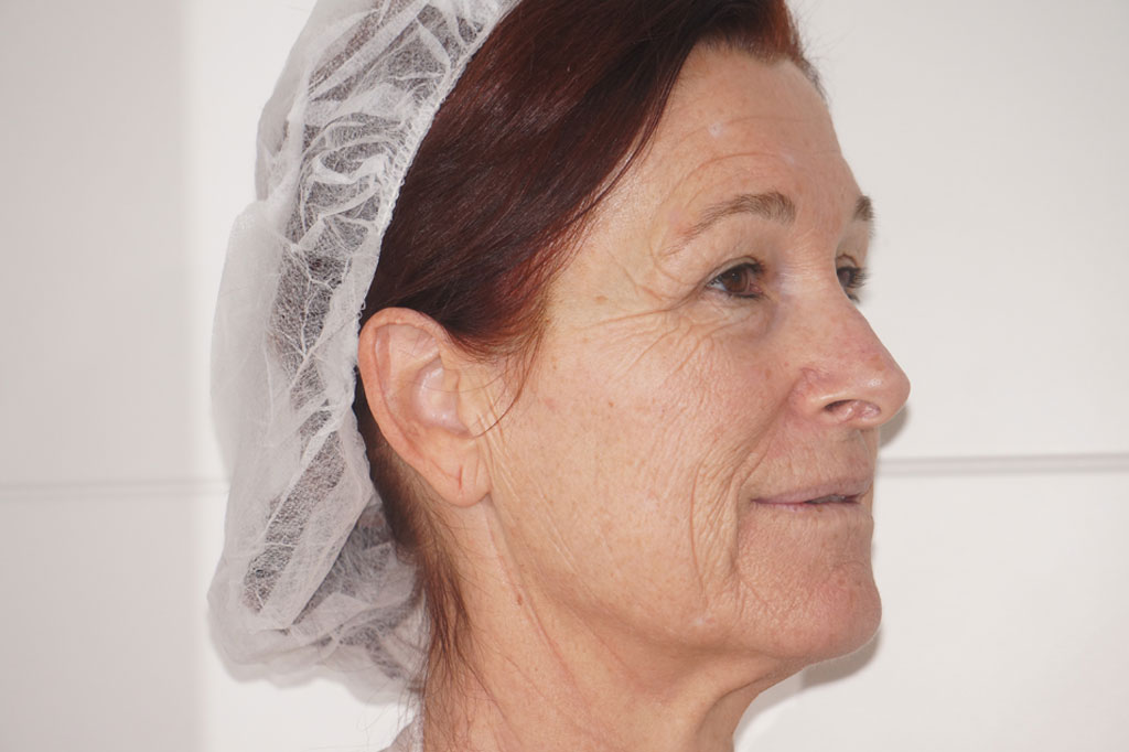 Peeling profundo FENOL ROSTRO COMPLETO ante/post-op III