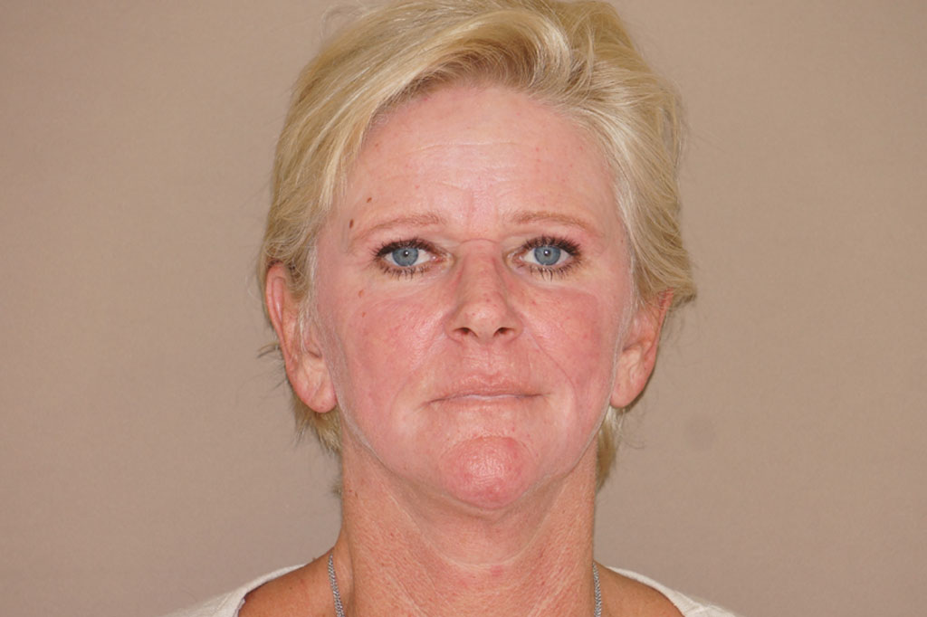 Photos Deep Peeling  ante/post-op I