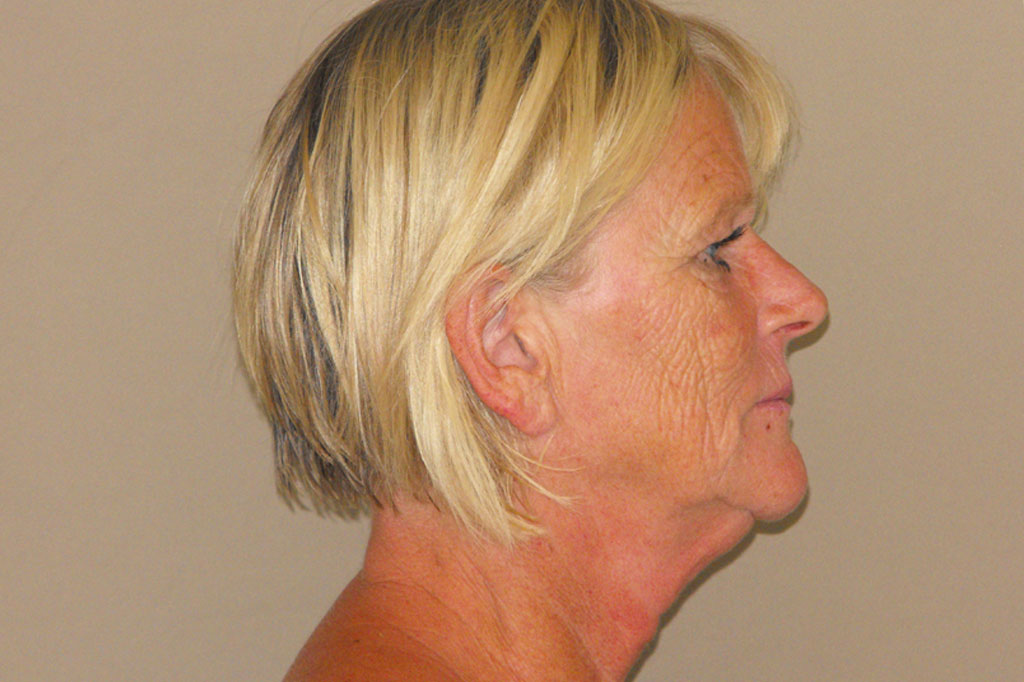 Photos Deep Peeling  ante/post-op III