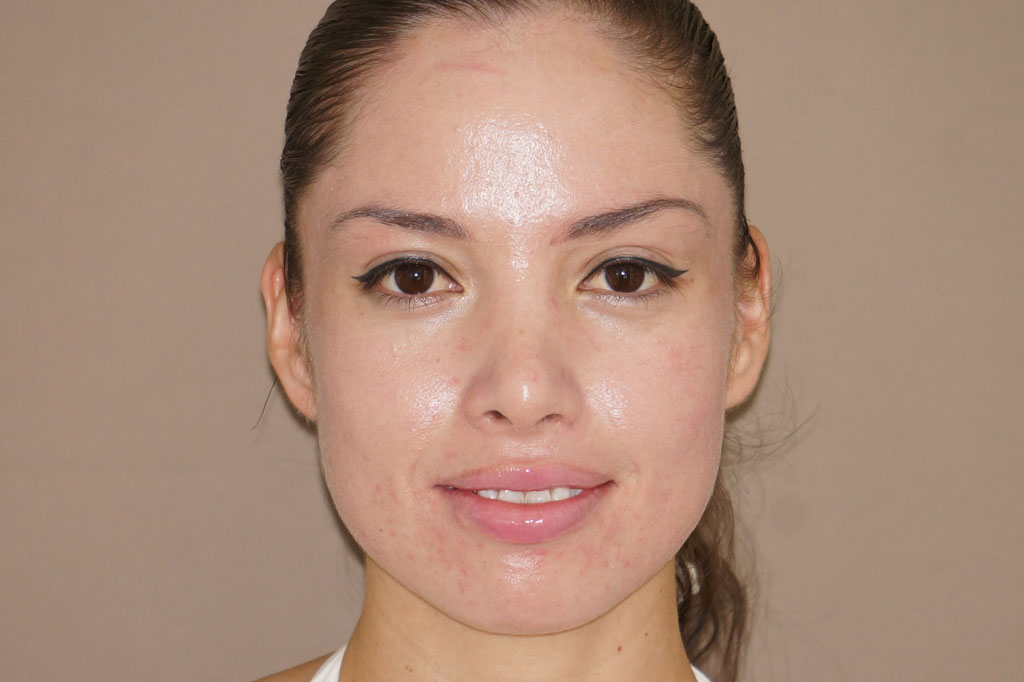 Tiefes Peeling Phenol Peel ante/post-op I