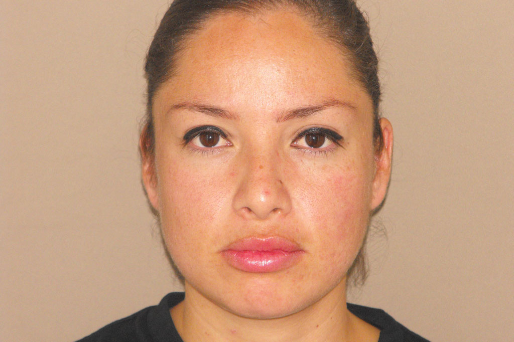 Photos Deep Peeling  ante/post-op I