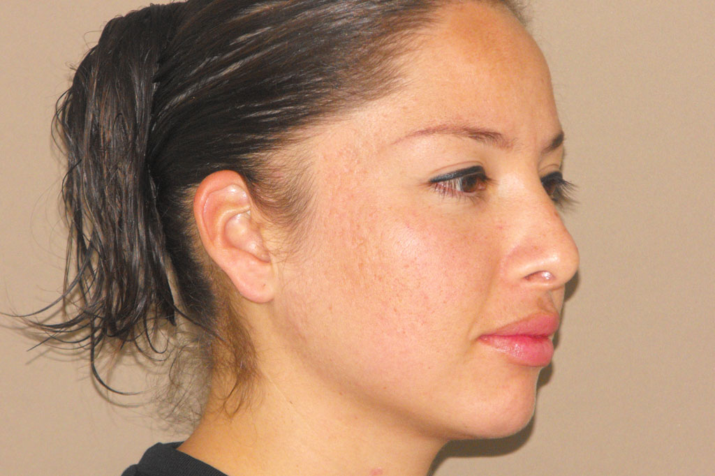 Photos Deep Peeling  ante/post-op II