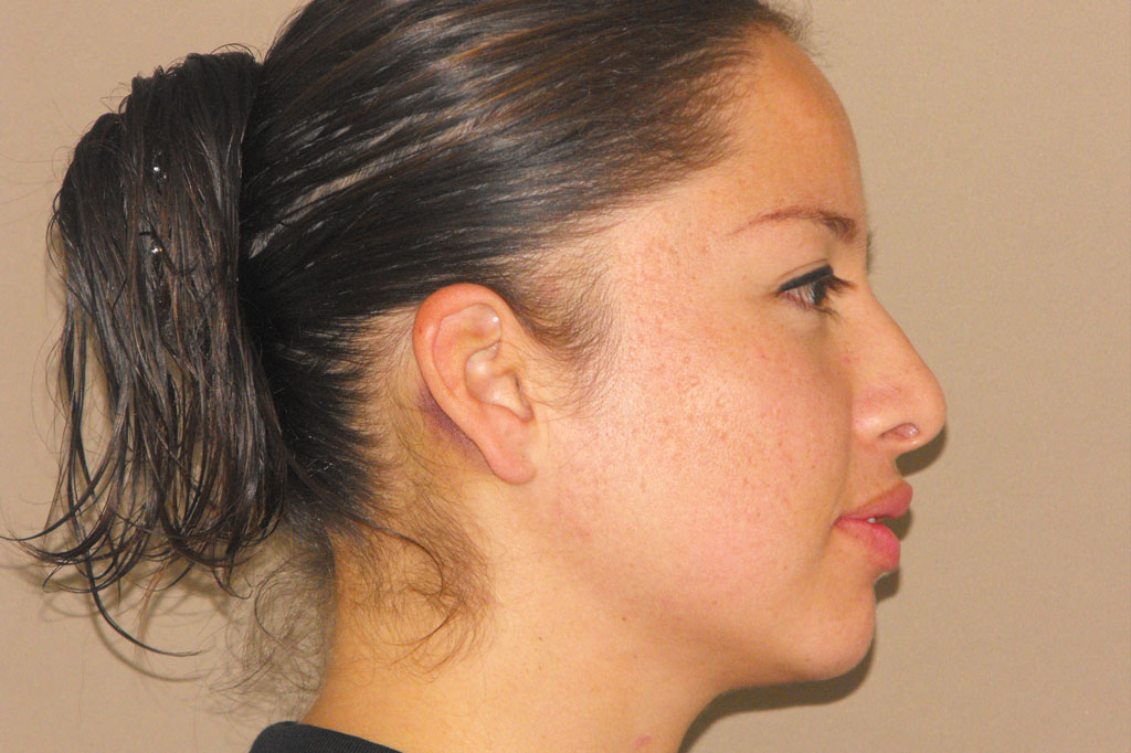 Photos Deep Peeling  ante/post-op III