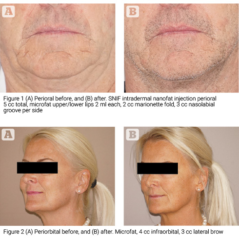 Facial rejuvenation