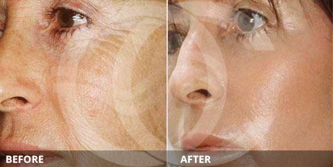 Anti-aging - Best for treating sun damage: Chemical peel