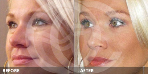 Anti-aging - Best for rejuvenation of eye area: Eyelid surgery