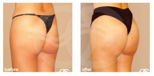 What are the best treatments for flat buttocks? Ocean Clinic Marbella Madrid