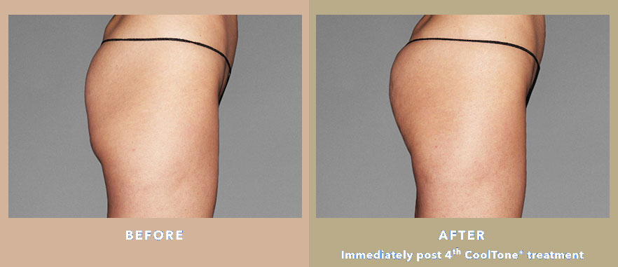 CoolTone - what you can do about flat bottom. Ocean Clinic Marbella Madrid