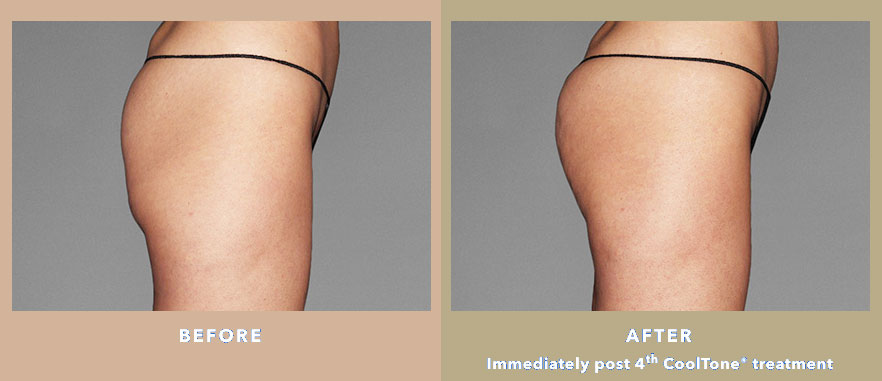 CoolTone - what you can do about flat bottom. Ocean Clinic Marbella