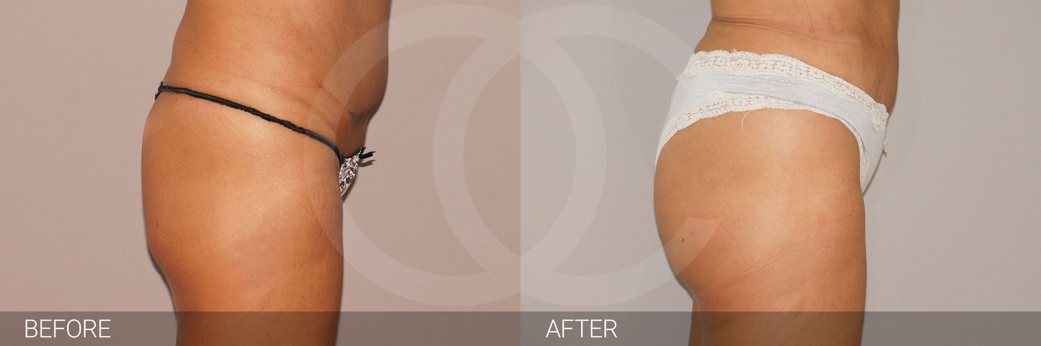 Fat transfer - what you can do about flat bottom. Ocean Clinic Marbella Madrid