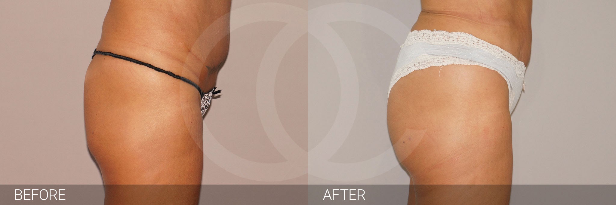 Fat transfer - what you can do about flat bottom. Ocean Clinic Marbella