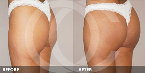 Does the Brazilian Butt Lift look fake? Marbella - Ocean Clinic