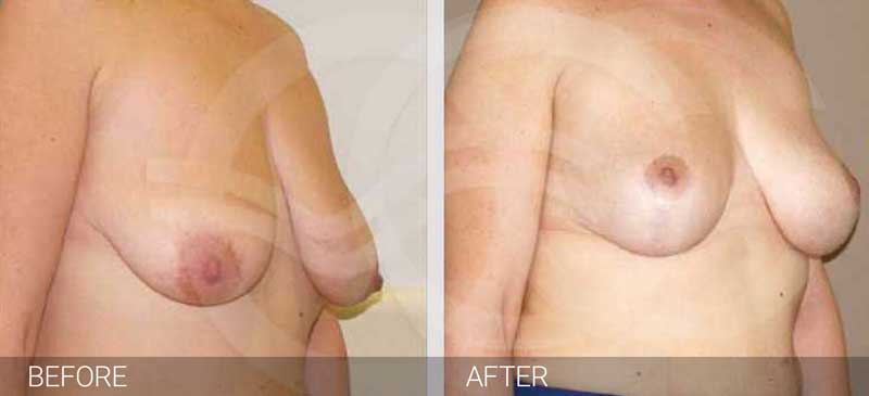 Breast lift - Before and after photo. Marbella Ocean Clinic