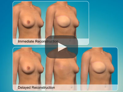 Breast reconstruction 3D animation | Marbella Ocean Clinic