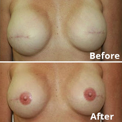 Breast reconstruction Before and After Photos | Marbella Ocean Clinic