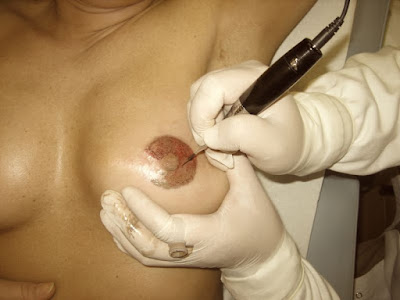 Nipple areola reconstruction using 3D Micropigmentation | Marbella Ocean Clinic