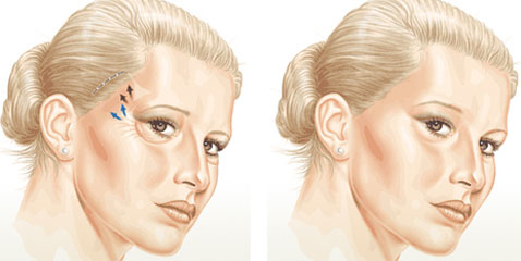 How are brow lift and blepharoplasty surgery carried out?