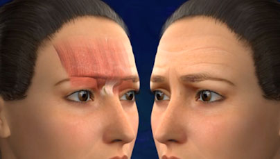 Surgical or Non-Surgical Brow Lift. Marbella Madrid Ocean Clinic