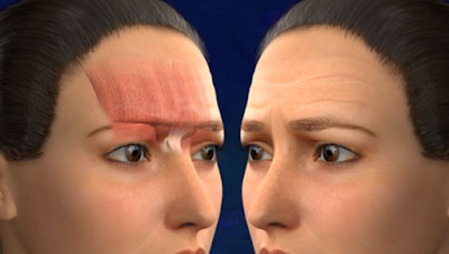 Surgical or Non-Surgical Brow Lift. Marbella Ocean Clinic