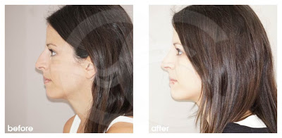 Why is traditional rhinoplasty usually the best option for fixing a dorsal hump?